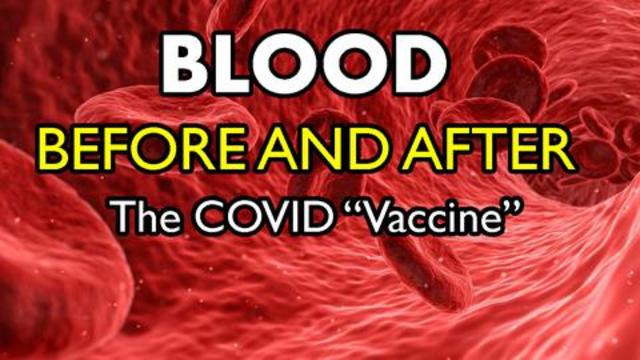 Vetted Images - Blood Before and After the mRNA COVID Vaccine Shot