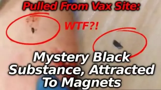 Black Junk Surgically Removed From Injection Site With Magnet & Scalpel